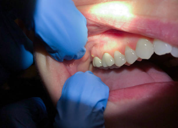 Best Emergency Treatment for Oral Infections in Lake Holiday, VA